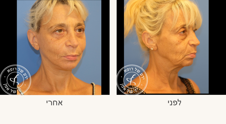 צילום לפני ואחרי של מטופלת שעברה ניתוח מתיחת פנים